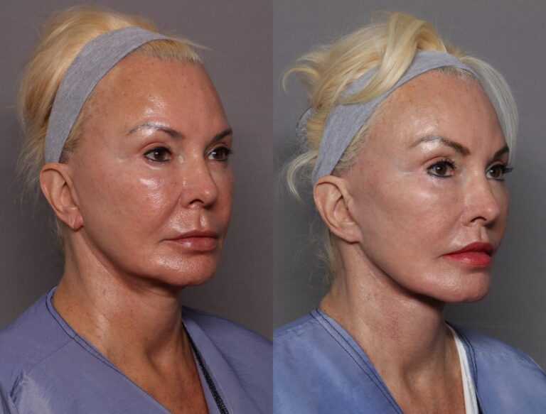 Does a Facelift Leave a Scar?