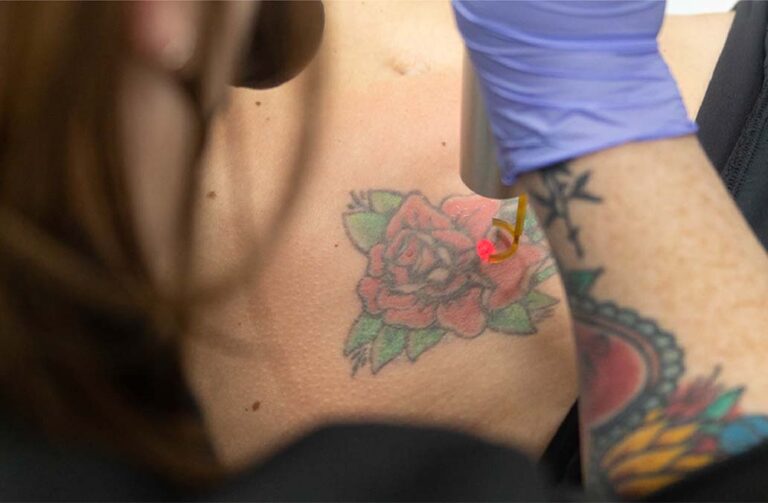 Aftercare Steps That Speed Up Tattoo Fading Aftercare Steps That Speed Up Tattoo Fading