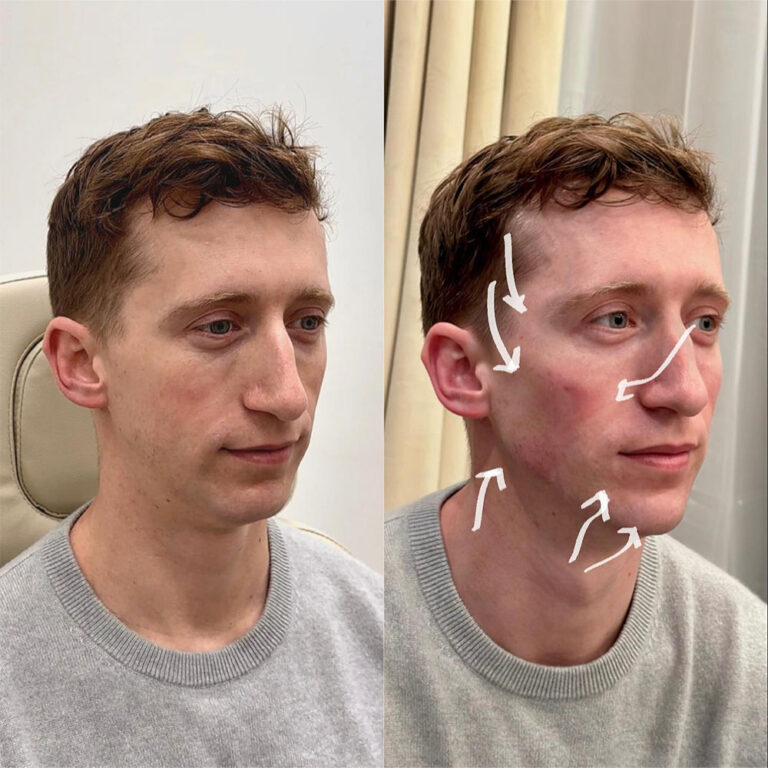 Exploring the Benefits of Facial Sculpting for Natural Beauty and Skin Wellness Facial Sculpting