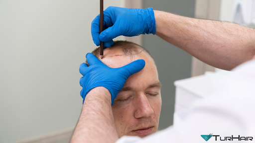 Hair Transplant Turkey